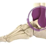 Ankle Fracture