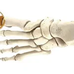 Medial Closing Wedge Osteotomy (Akin)