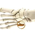 Proximal 5th Metatarsal Fracture (Jones Fracture)