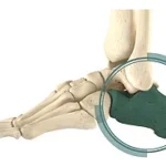 Calcaneal Fracture