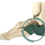 Calcaneo-cuboid Arthrodesis