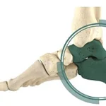 Subtalar Joint Arthrodesis (Talocalcaneal Arthrodesis)