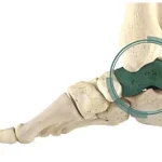 Talus Fracture