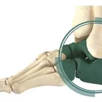 Triple Arthrodesis