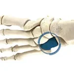 Cuboid Fracture