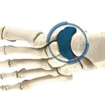 Navicular Fracture