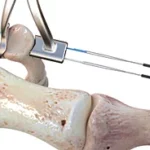 Gravity Plantar Plate